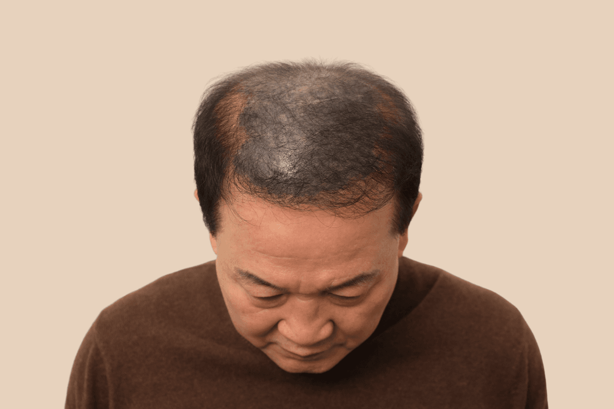 타 업체 시술 후 어색해진 두피를 자연스럽게 재교정한 사례 비포