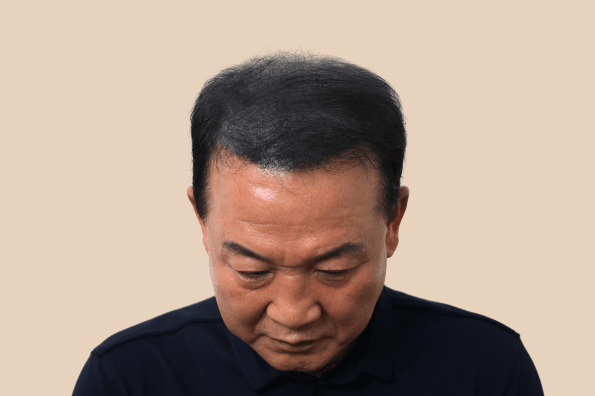 타 업체 시술 후 어색해진 두피를 자연스럽게 재교정한 사례 애프터