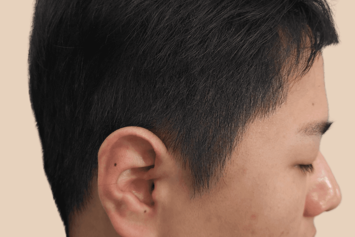 측두부 밀도를 자연스럽게 보완한 사례 애프터