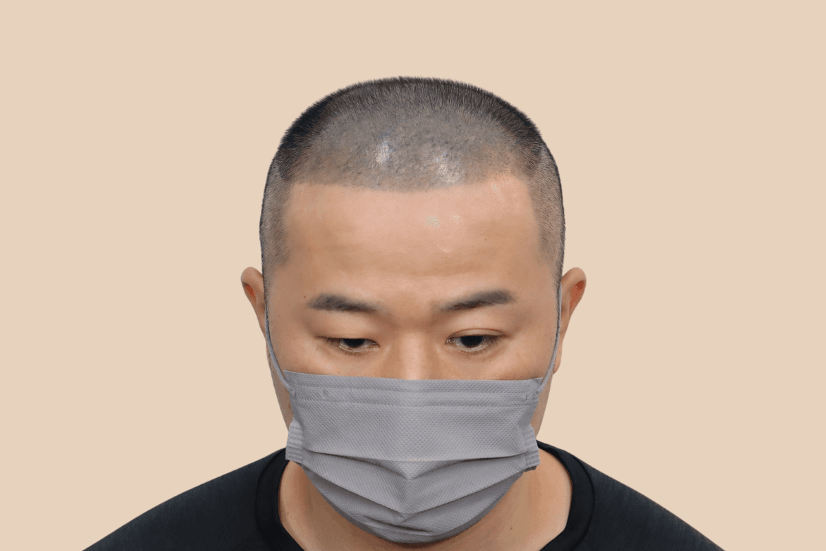 타 업체 시술 후 어색해진 두피를 자연스럽게 재교정한 사례 비포