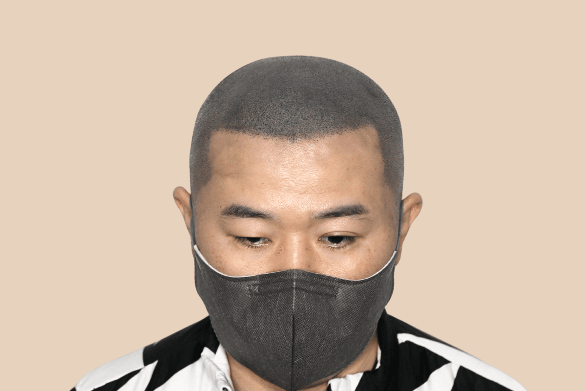 타 업체 시술 후 어색해진 두피를 자연스럽게 재교정한 사례 애프터